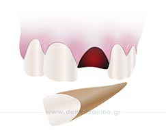 Δόντι εκτός στόματος 